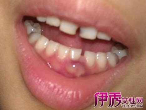 【牙龈上长了个肉疙瘩】【图】牙龈上长了个肉疙瘩是什么 怎么预防牙病(3)_伊秀健康|yxlady.com