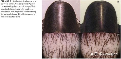女性脱发头皮中胚层头皮美塑治疗前后 - 微医（挂号网）