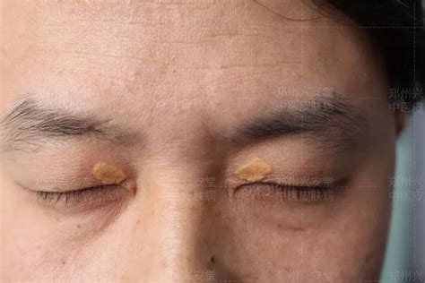 眼肿瘤系列科普—眼皮上长了黄色斑块，是黄色瘤吗？也可能是黄色肉芽肿 - 微医（挂号网）