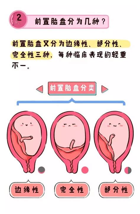 前置胎盘有多可怕？孕期阴道反复流血怎么办？|前置胎盘|胎盘|阴道出血_新浪新闻