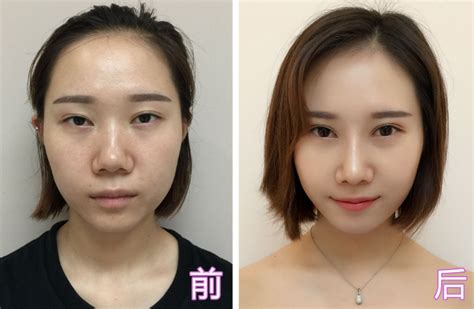 韩式肋骨隆鼻手术个人经历分享前后对比照片_珍美网