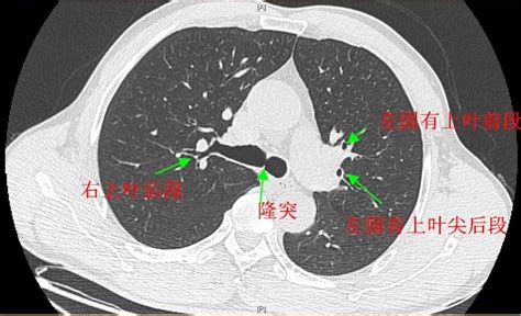 【图文详析】支气管扩张的机制、影像特征和病因-搜狐大视野-搜狐新闻