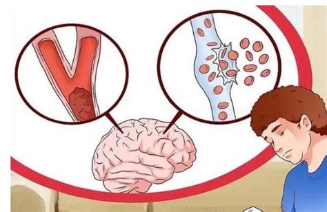 “头部”出现5个征兆，可能脑梗要发生，有三类人要注意|血液|脑血管|脑梗塞_新浪新闻