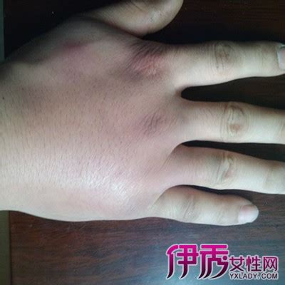 双手无名指关节对称疼，手握拳无力无名指关节痛是什么原因
