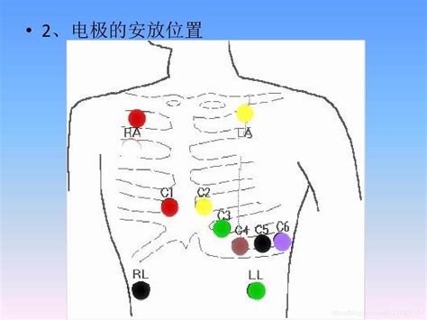 心电图连接示意图图片