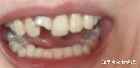 牙齿龋坏到什么程度，需要做根管治疗？ - 知乎