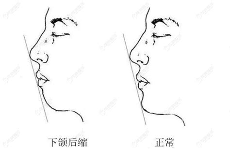 颏部具体位置图片