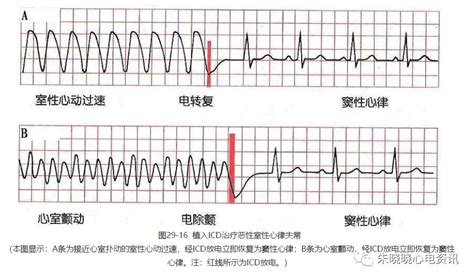 室颤的心电图图片
