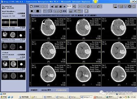 CT、磁共振报告上的“脑萎缩”是什么？或是3种疾病引起，要留心