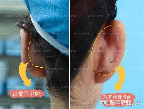 耳朵软骨突出图片