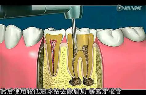详细牙齿根管治疗全过程（动画演示）_标清