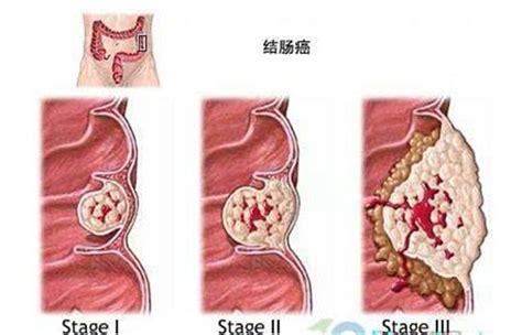 结直肠癌个体化治疗基因检测(61基因）-北京基石生命科技有限公司