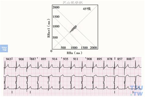 心脏起搏心电图常用的术语 - 心血管 - 天山医学院
