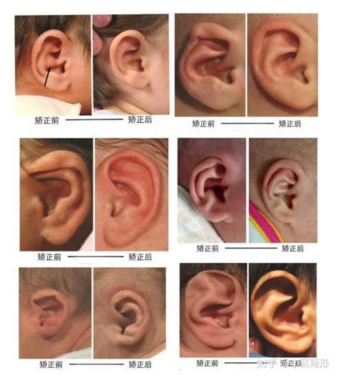 耳朵软骨突出图片