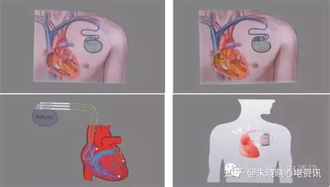 植入式心脏起搏器 ULTRA DR 1291 乐普-心脏起搏器-寰熙医疗