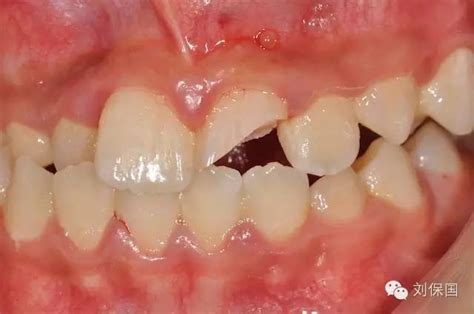 断牙再接术：救活你的牙齿 刘保国-牙医刘保国的博客-KQ88口腔博客