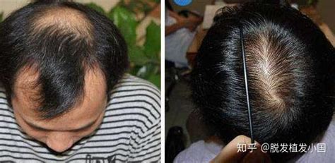 用头发种植效果证实北京薇琳植发是正规医院,还带价格表哟 - 热点资讯 - 毛毛网