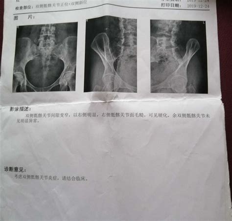 骶髂关节位置图图片