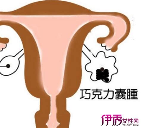 卵巢囊肿是怎么形成的原因（女性为什么会卵巢囊肿？有以下几种因素需要注意啦） | 说明书网