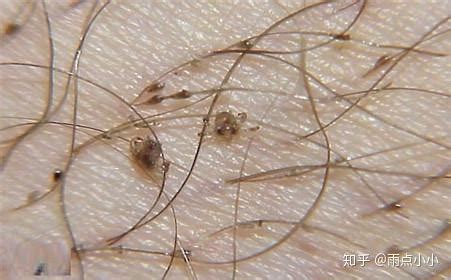 虱子是怎么来的在头发上（小时候头上长虱子是怎么回事？虱子又分别有哪几种？） | 说明书网