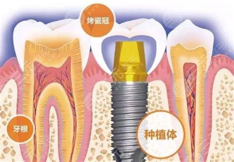 杭州口腔医院种植牙怎么样？手术成好吗？附价格表+种牙过程-三元整形网