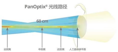 重庆市首批！三焦点散光人工晶体手术在重庆普瑞眼科成功植入_凤凰网区域_凤凰网