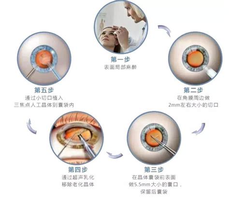 2023年白内障免费治疗政策:附上海/长沙/四川等地免费政策,近视眼矫正-8682整形网