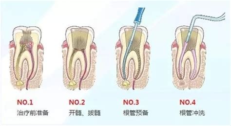 现代口腔标准根管治疗流程