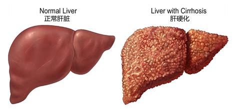 如果肝脏可以再生，那么肝硬化的病人为什么不能通过切除部分肝脏来治疗？ - 知乎