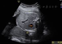 胎儿肠旋转不良合并十二指肠扭转超声表现1例 - 中华超声影像学杂志