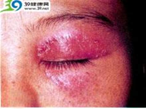 眼睛周围湿疹图片