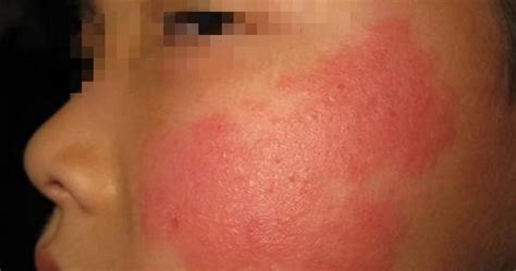 脸上反复起密密麻麻的小红疹子特别痒是不是激素脸