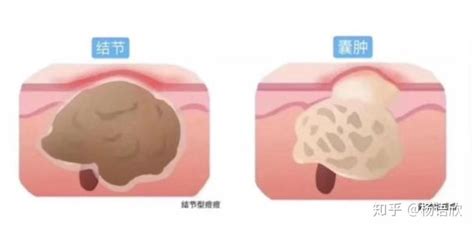 皮肤囊肿图片