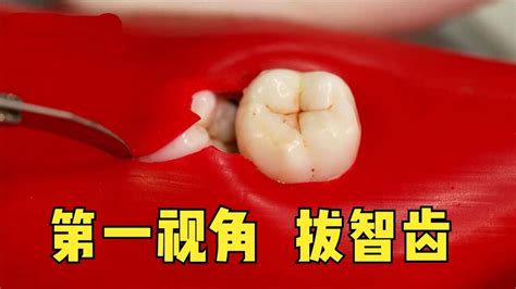 第一视角拔智齿，手术刀切开牙龈，电钻将牙齿一分为二，看着真疼
