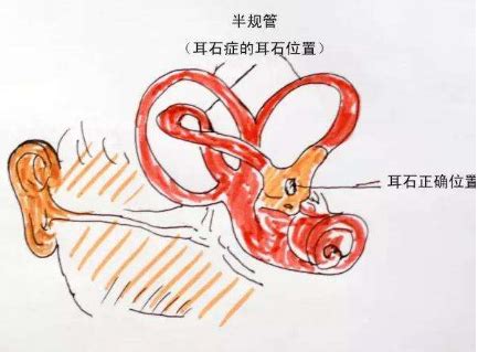 耳石症图片