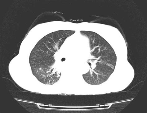 5种肺部感染的影像学鉴别（多图）
