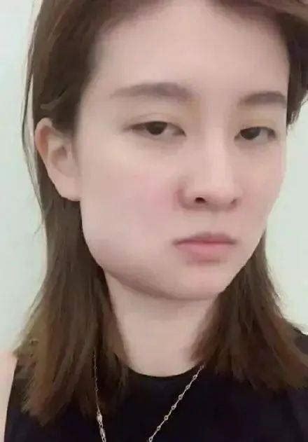 腮腺肿瘤早期图片