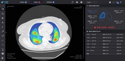 南开大学与推想科技利用CT影像AI筛查助力新冠肺炎疫情防控-南开要闻-南开大学