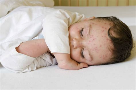 宝宝水痘症状图片有哪些（这种疹子传染性加强，日常预防家长要这样做） | 说明书网