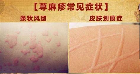 麻诊病图片