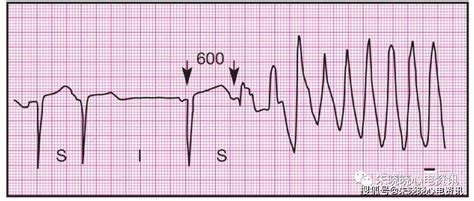 心电图T波低平、T波倒置，就是心脏病吗？_复查
