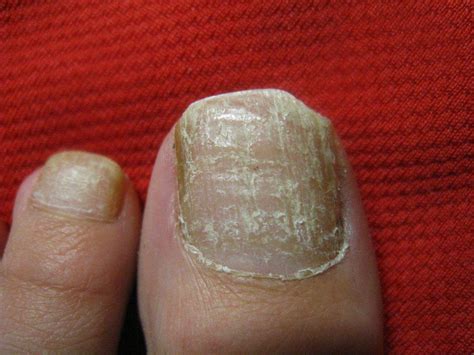 在家治疗灰指甲，教你一个方法，灰指甲再不复发