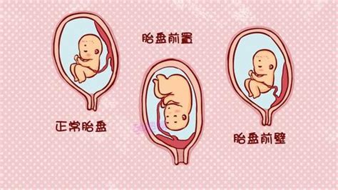 胎盘低置怎么长上去（胎盘低怎么办？孕妈不要害怕，想要胎盘长上去，孕期做好这4点！） | 说明书网