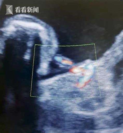 33岁女子孕检发现"胎中胎" 手脚齐全却无心缺脑_时讯_看看新闻