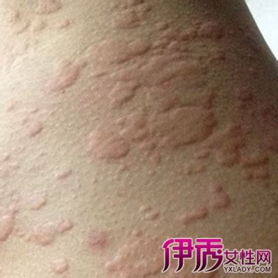 麻诊病图片