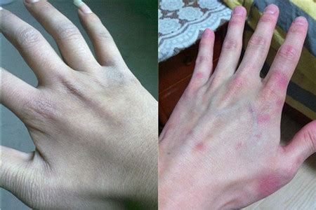手背上有很多青筋鼓起，这是血管疾病？原来是这3个原因导致|血管|青筋|手背_新浪新闻