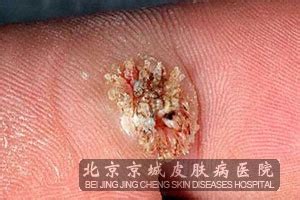 血瘊子图片