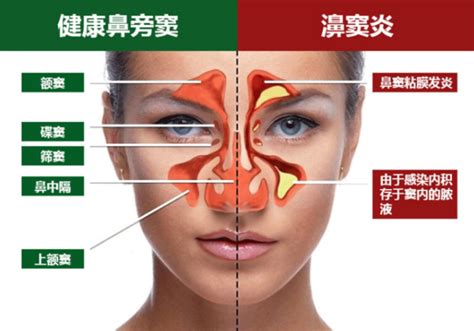 鼻窦炎和鼻炎区别视频鼻窦炎和鼻炎哪个严重2022已更新今日资讯