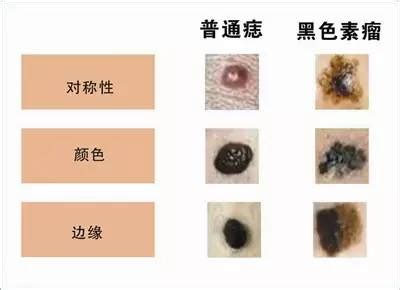痦子图片