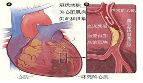 【话说胸痛】发生急性心肌梗死后该怎么办？_重庆东华医院